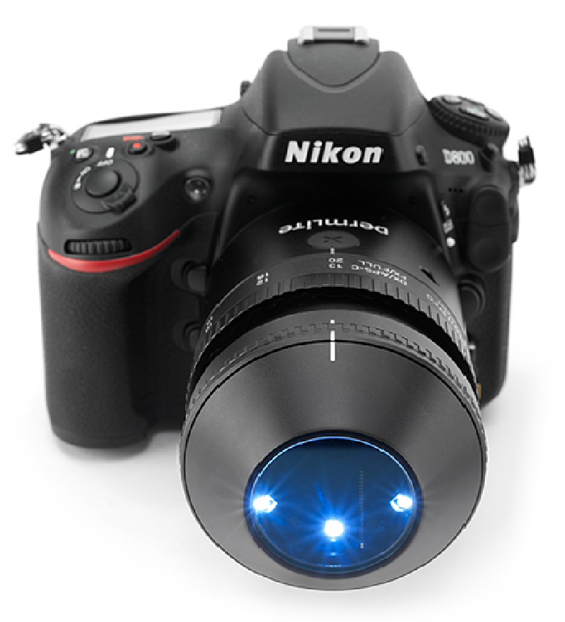 DermLite Foto II Pro dermatoscope attached to Nikon camera.