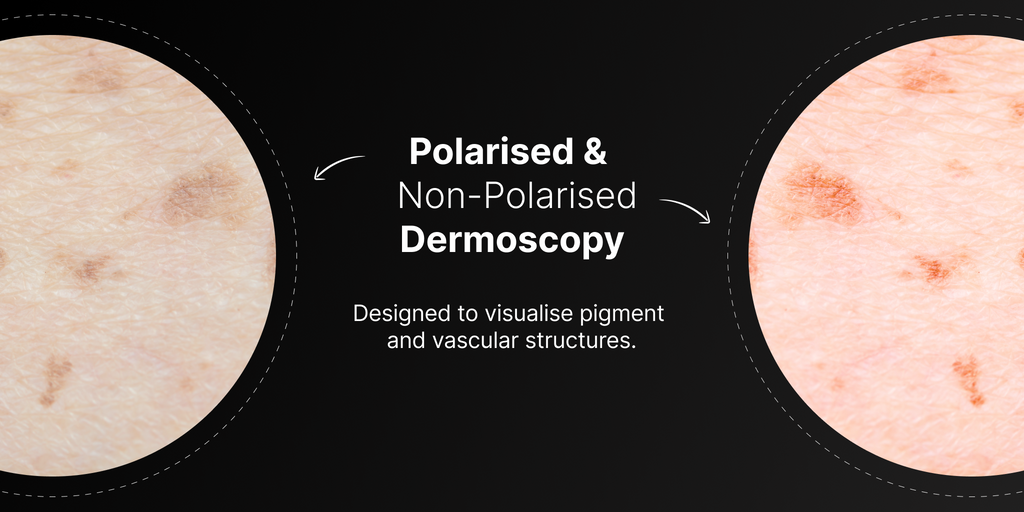 Polarised & Non-Polarised Dermoscopy