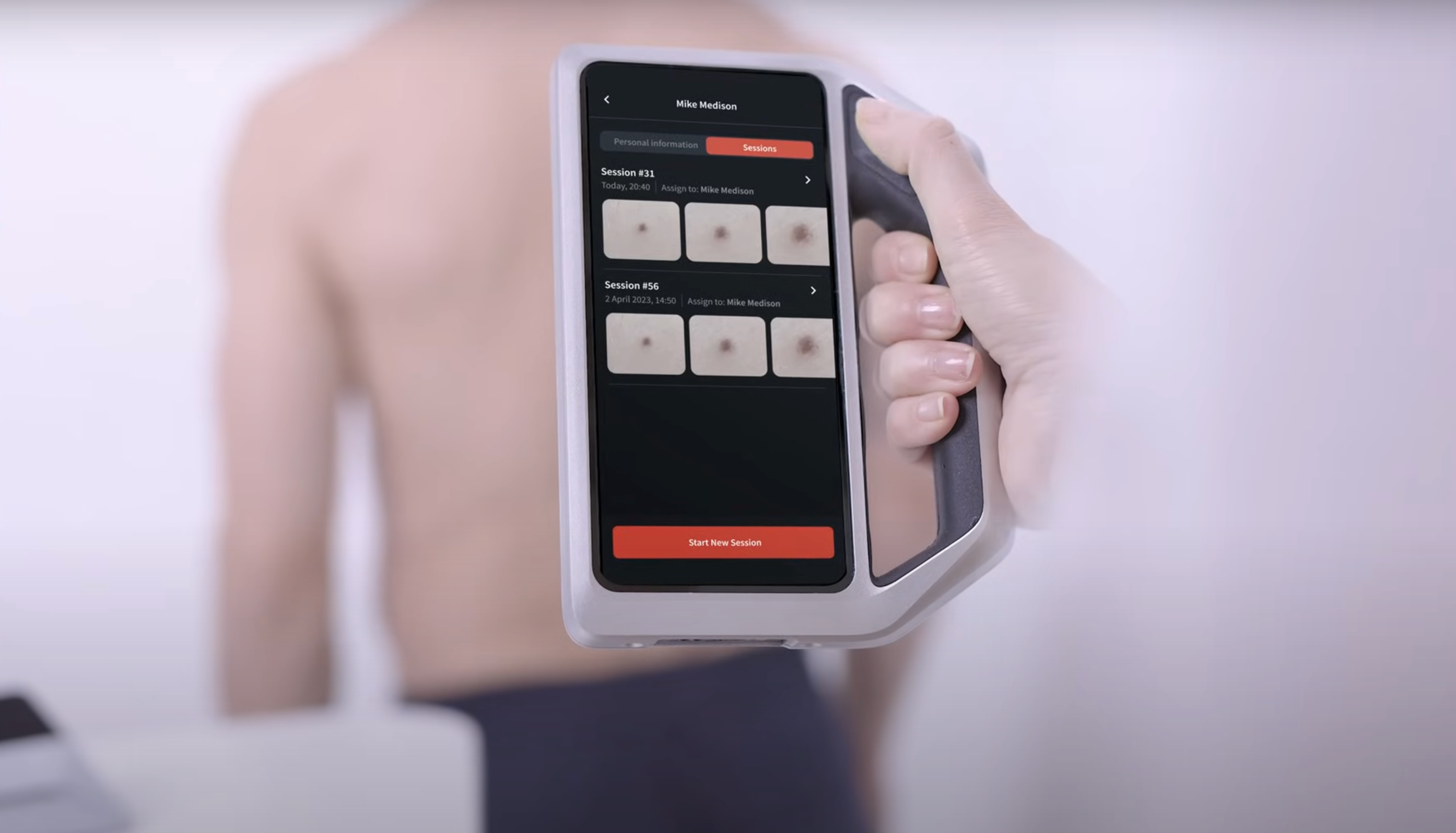 Load video: FotoFinder Skeen