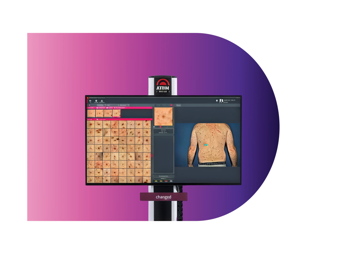 FotoFinder ATBM tracking patient's mole history