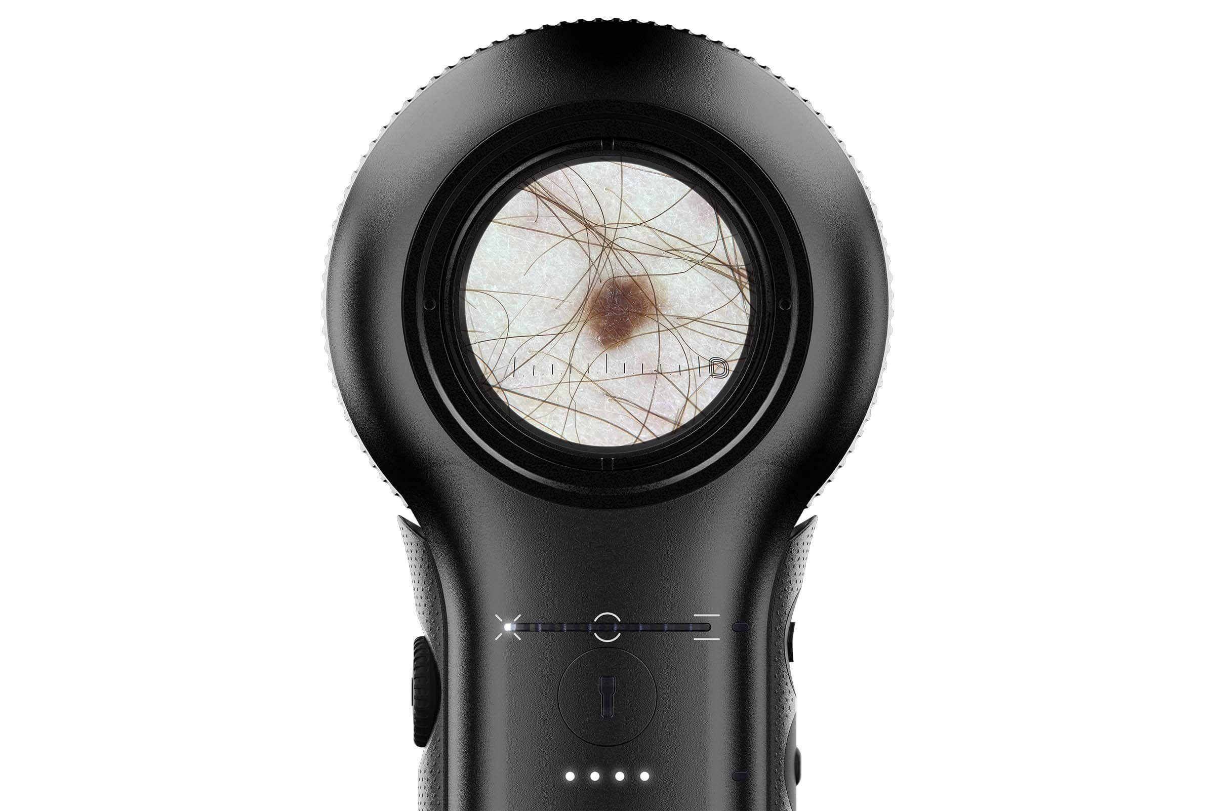 DermLite DL5 dermatoscope viewing a lesion with polarised white light.