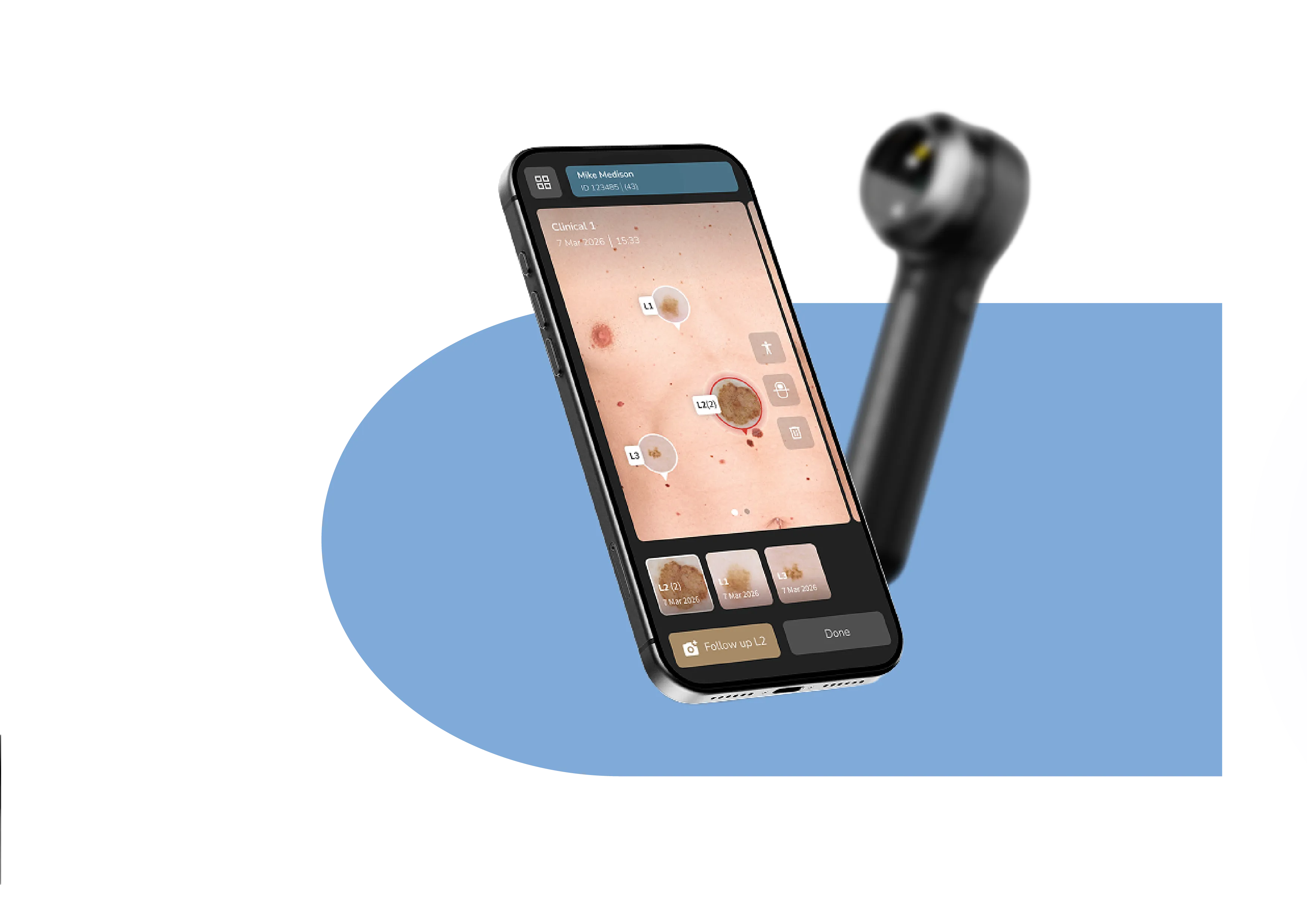 Using DL5 Plus and DermLite app to compare lesion images from follow-ups