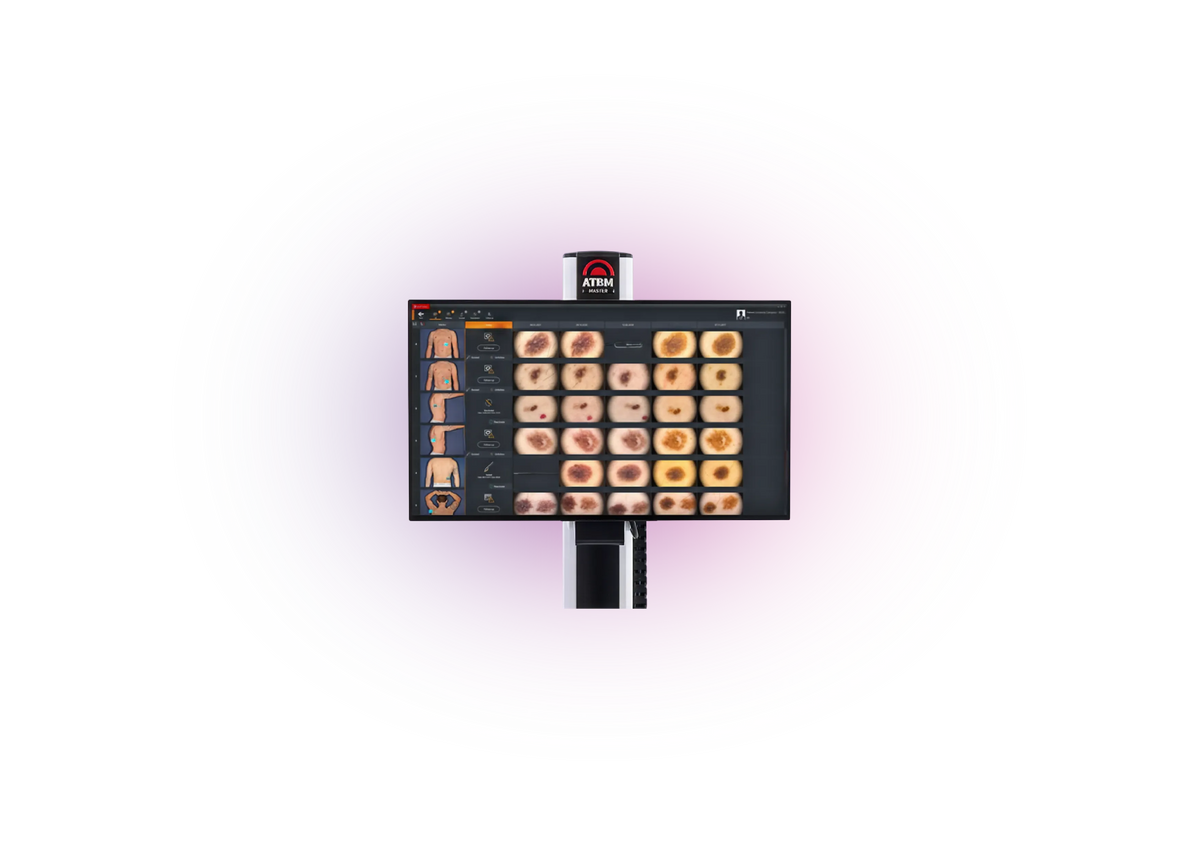 FotoFinder ATBM comparing moles