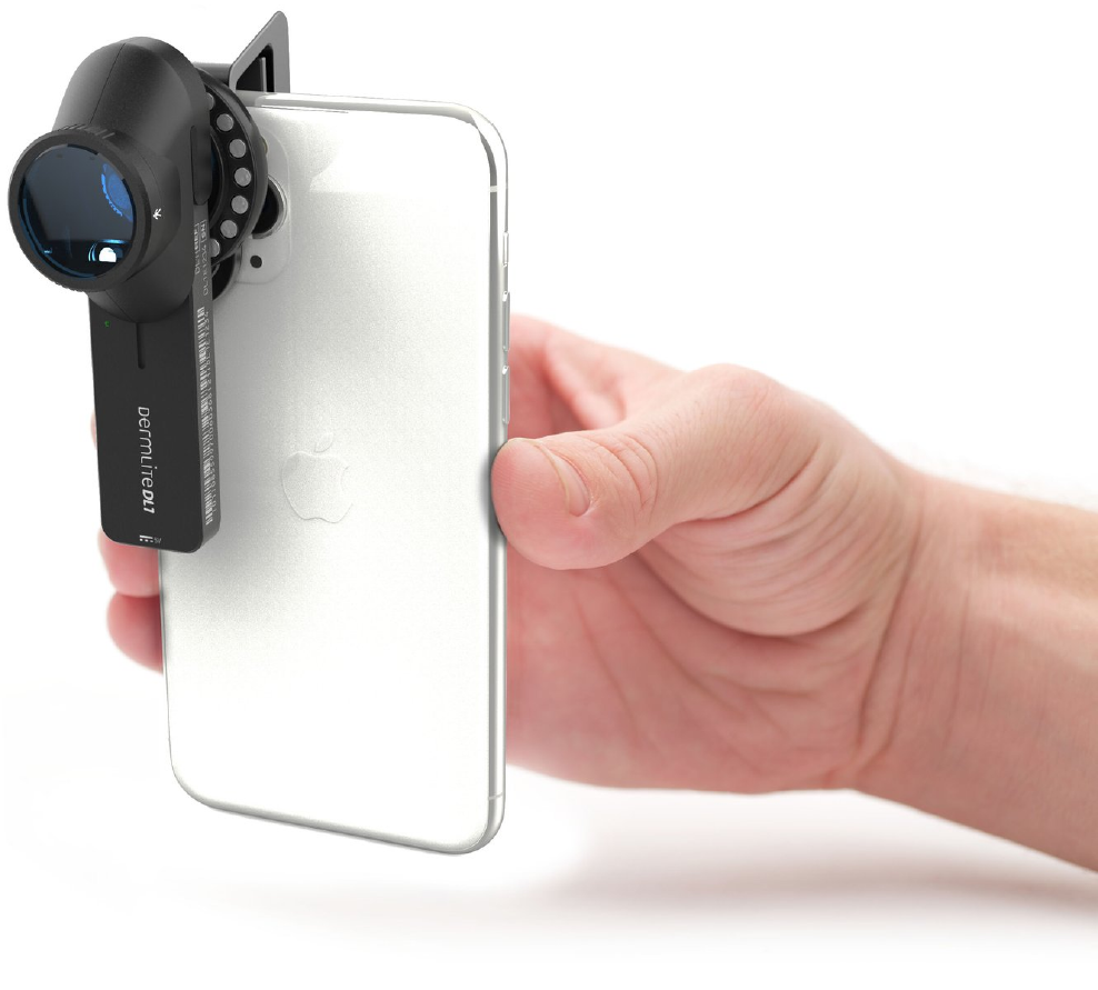 Hand holding iPhone with DermLite DL1 dermatoscope connected.